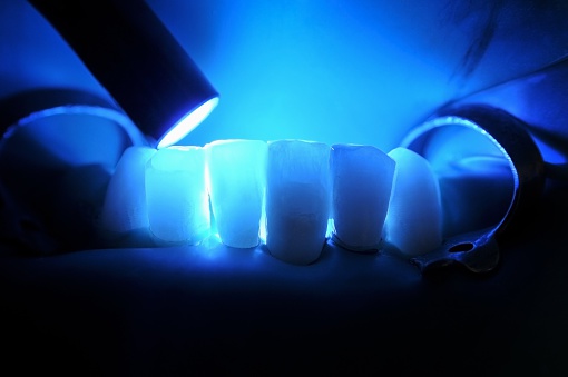 Close up of composite fillings from Grins and Giggles Family Dentistry in Spokane Valley, WA.