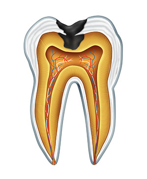 Illustrated diagram of a cavity from Grins and Giggles Family Dentistry in Spokane Valley, WA