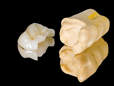 Dental inlays and onlays by Grins & Giggles Family Dentistry in Spokane Valley, WA.