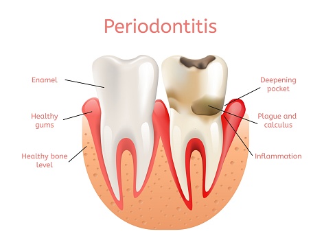 Periodontal disease treatment at Grins & Giggles Family Dentistry in Spokane Valley, WA 