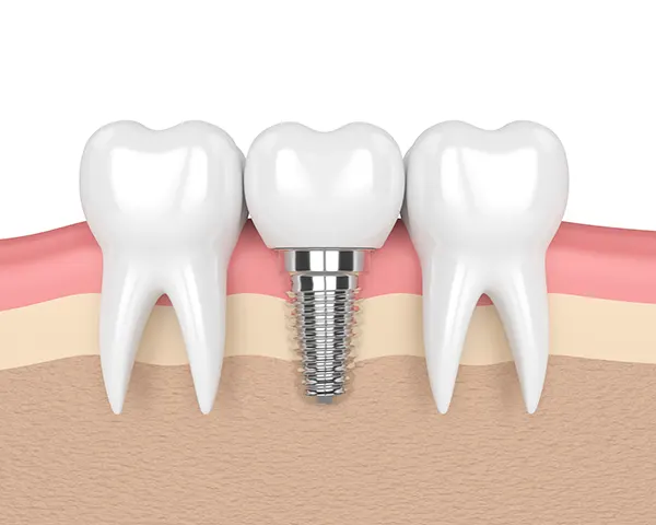 3D rendered cross-section view of a dental implant placed in the jaw between two healthy teeth illustrated by Grins & Giggles Family Dentistry in Spokane Valley, WA