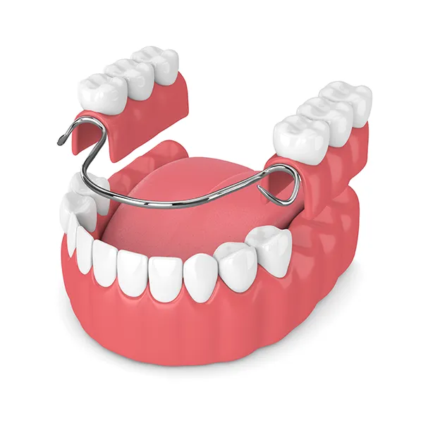 3D rendering of partial dentures being placed on a lower jaw with missing back teeth illustrated by Grins & Giggles Family Dentistry in Spokane Valley, WA
